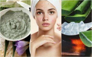 5 naturlige behandlinger mot kviser i ansiktet