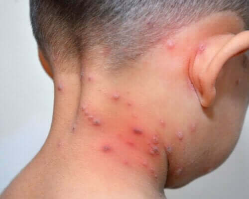 Et barn med herpes.