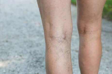 Dårlig sirkulasjon i bena kan forårsake muskelkramper