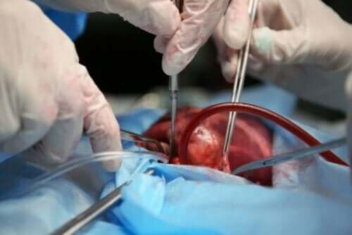 Kirurger som opererer medfødt hjertefeil.