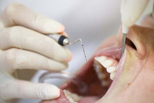 Periodontitt: En problematisk tannkjøttsykdom