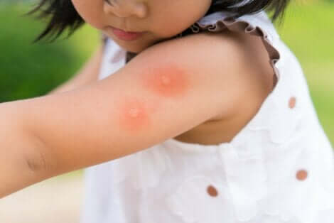 Ung jente med myggstikk på armen.