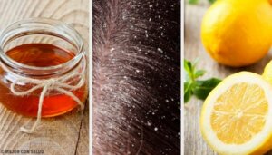 10 effektive naturlige remedier mot flass