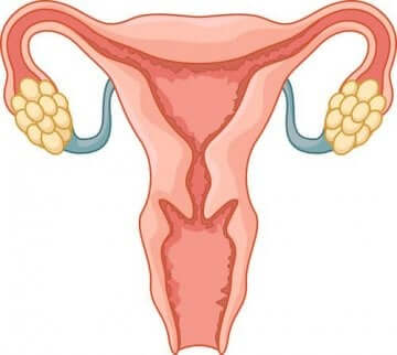 Polycystisk ovariesyndrom er en årsak til infertilitet hos kvinner.