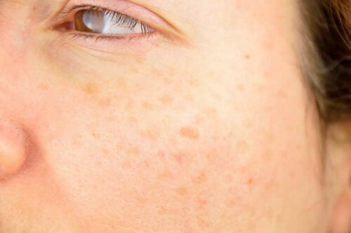 Flekker er en av de vanligste hudproblemene.