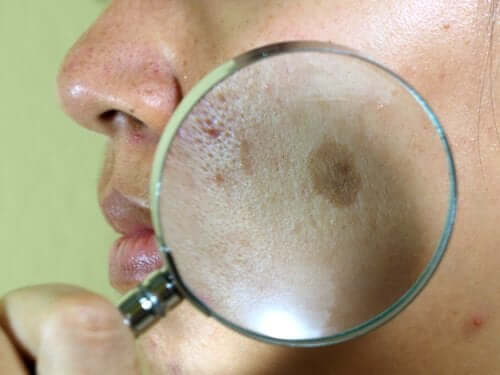 Melasma.