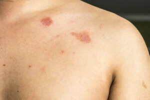 Beskrivelse og kjennetegn ved Pityriasis versicolor