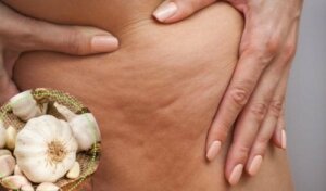 Fem forskjellige måter å bekjempe infeksiøs cellulitt på