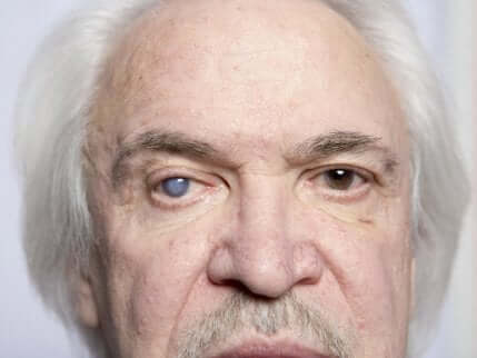 Hva forårsaker grå stær?