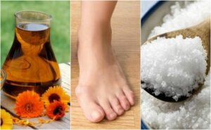 4 naturlige remedier for hallux valgus