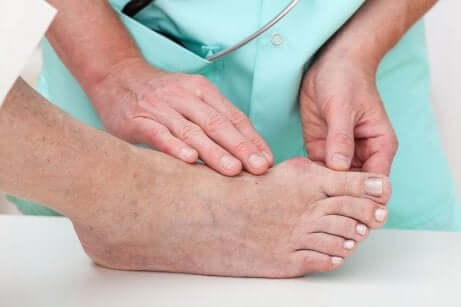 Person med hallux valgus