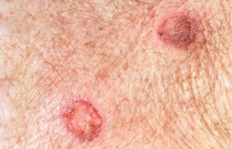 Føflekker og melanom