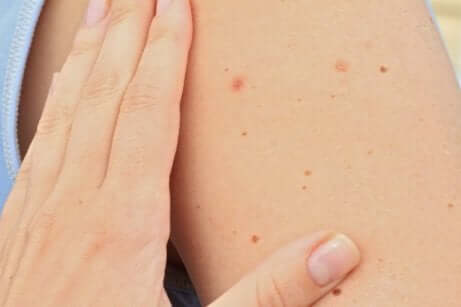 Hva er riktig behandling for en unormal føflekk