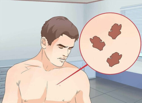 Hva er riktig behandling for en unormal føflekk?