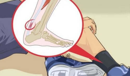 Årsaker til akillessenebetennelse