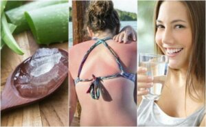 Ni måter å behandle solbrenthet på