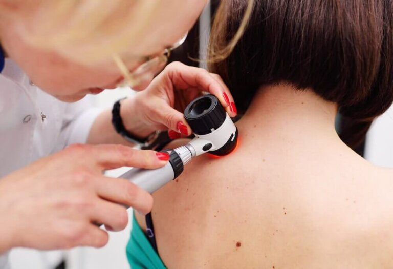 Er melanom den eneste alvorlige typen hudkreft?