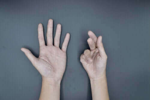 Årsaker til Dupuytrens kontraktur og behandlinger