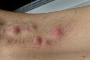 Kan kosthold forbedre hidradenitis suppurativa?