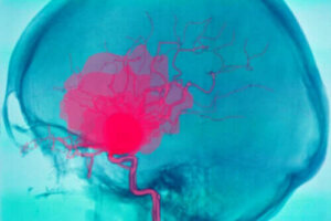 Hva er en intracerebral blødning og hvorfor kan det forekomme?