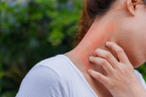 Sammenhengen mellom dermatitt og kortikosteroider