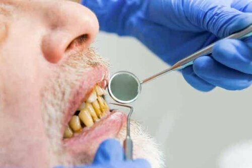 En mann med melanose som er hos tannlegen.