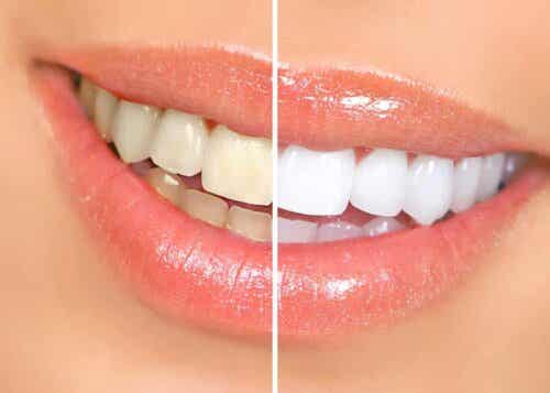 En sammenligning av hvite og gule tenner.