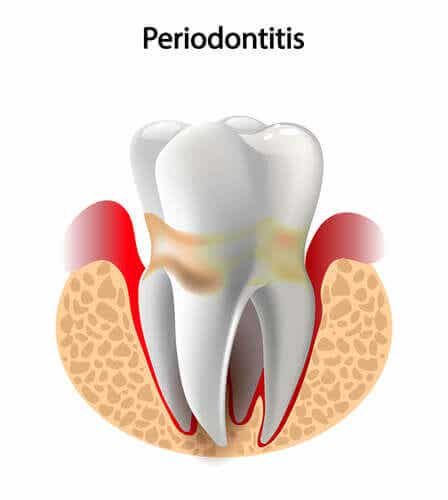 En tann med periodontitt.
