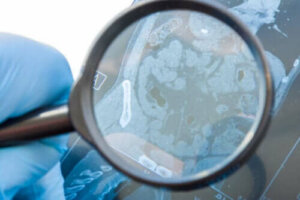 Hva er en gastrointestinal fistel, og hva forårsaker det?