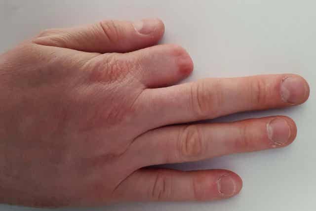 En hånd med en amputert finger