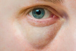 Årsaker til hovne øyelokk og behandlinger