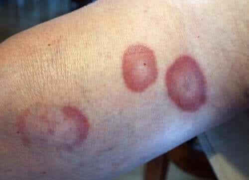 Røde sirkulære skader på en persons arm.