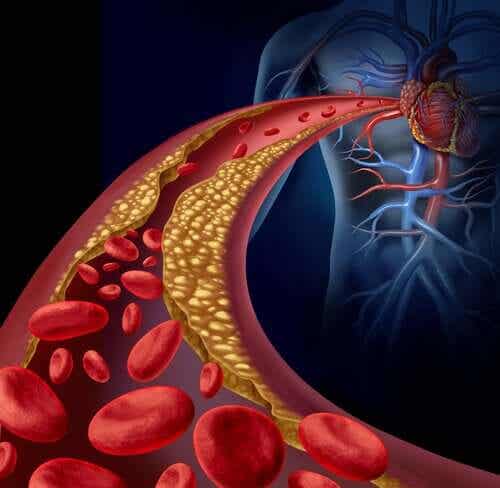 En illustrasjon av en koagulert arterie.