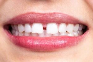 Kjennetegn og årsaker til tanndiastem