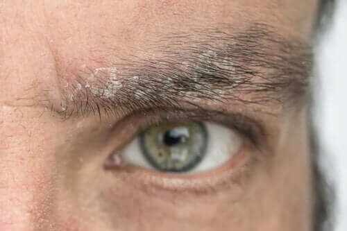 Flass i øyenbrynene: Hvorfor forekommer det og hvordan bli kvitt det