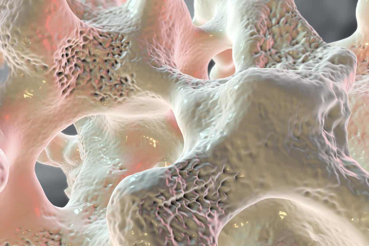 Osteoporose i et bein.