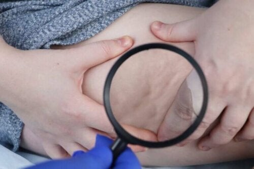 Verdens lipodystrofidag: Hvorfor feires det?