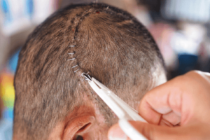 Hva er en kraniotomi og når er det nødvendig?