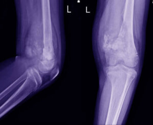 Kjennetegn ved osteosarkom hos barn