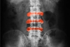 Verdens ankyloserende spondylittdag