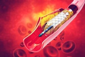 Stent i arterier: Alt du trenger å vite