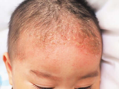Hva er Seboreisk dermatitt hos spedbarn?