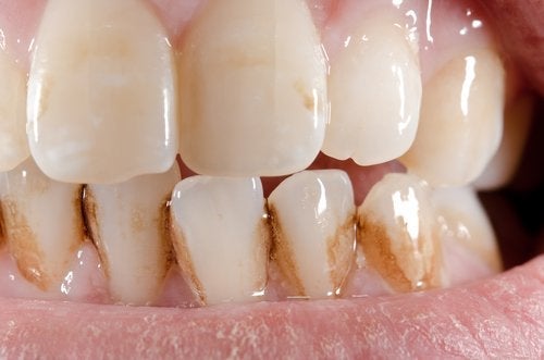 Hvordan fjerne tannstein fra tennene dine naturlig