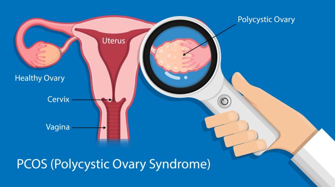 Naturlige behandlinger for polycystisk ovariesyndrom