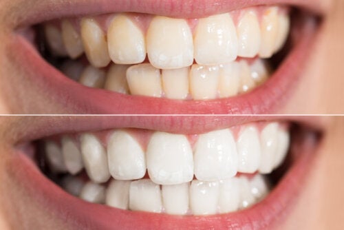 Er det trygt å bleke tennene hjemme? Mulige risikoer og anbefalinger