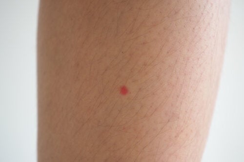 Hva er de røde flekkene på bena mine, og hva kan jeg gjøre med dem?