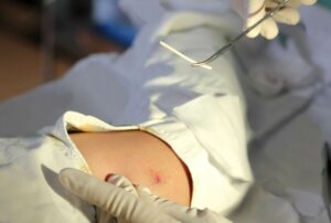 Kan du fortsatt bli gravid med et progestinimplantat?