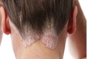 De 6 beste naturlige midlene for å bekjempe ringorm i hodebunnen