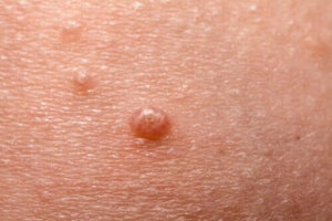 Alt om Molluscum contagiosum
