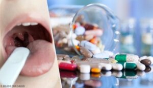 Behandling for akutt tonsillitt